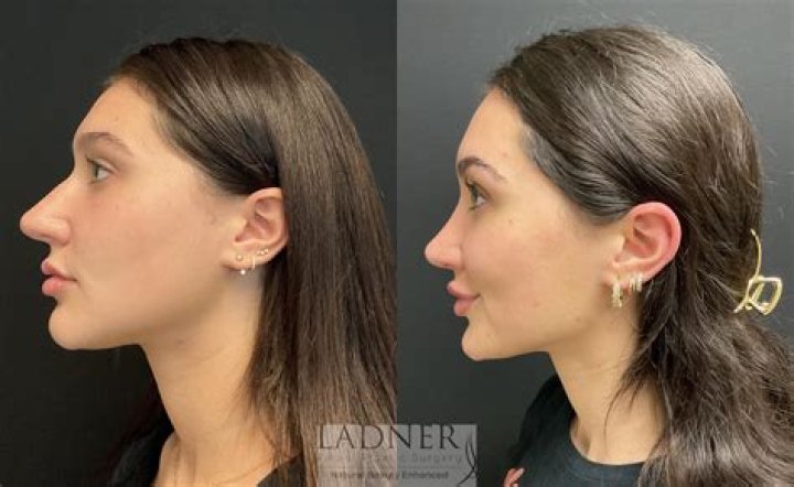 Ana De Armas | Get Her Nose Done? Plastic Surgery Before