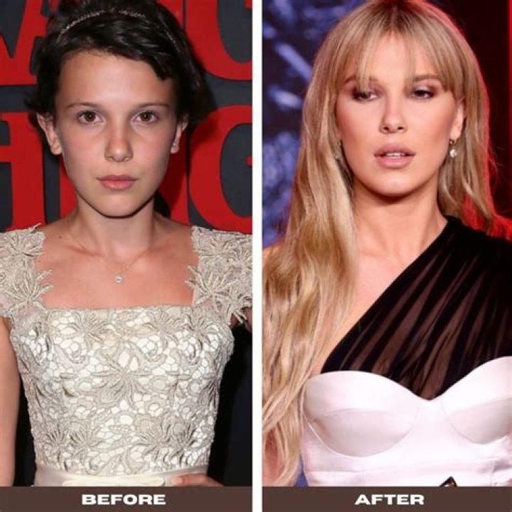 How Did Millie Bobby Brown Look Before And After Plastic Surgery