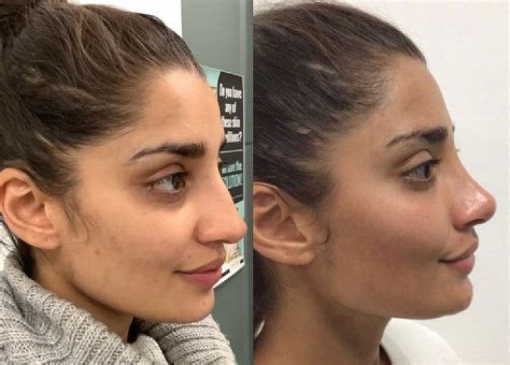 Riz Ahmed Nose Job | Before And After Photos