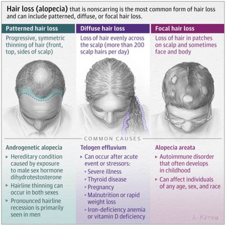 Was Darren Kent Hair Loss Linked To Alopecia | Skin Disorder